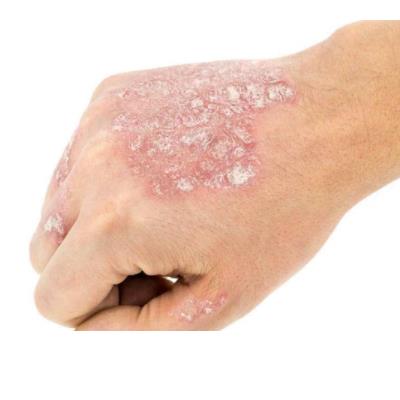 病例：男、65岁 银屑病