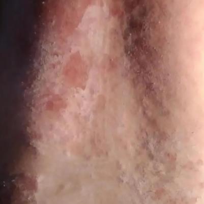 病例：男、72岁 湿疹