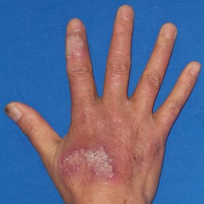 病例：男、65岁 孢子丝菌病